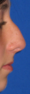 cirugia plastica de nariz - rinoplastia - chile
